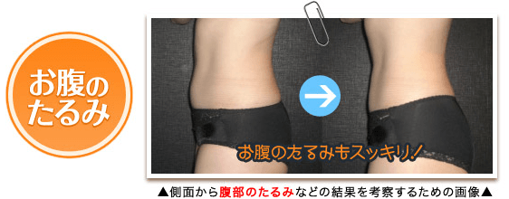 お腹のたるみ